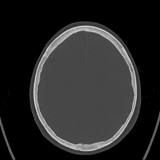 Cerebral venous infarction with hemorrhage (Radiopaedia 65343-74381 Axial bone window 133).jpg