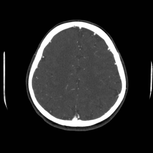 Cerebral venous sinus thrombosis (Radiopaedia 40619-43227 A 172).jpg