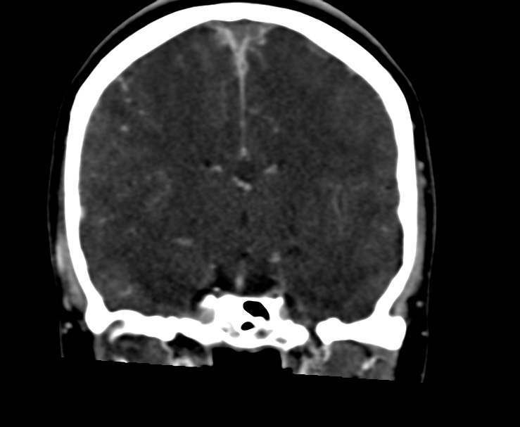 Cerebral venous sinus thrombosis (Radiopaedia 59224-66646 Coronal C+ delayed 39).jpg