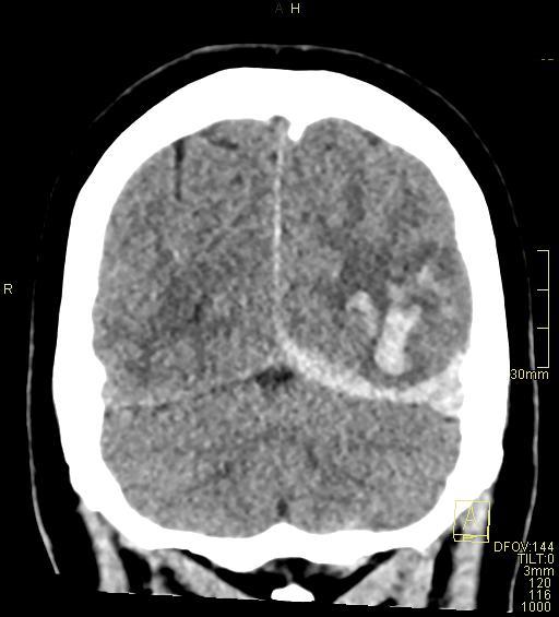 Cerebral venous sinus thrombosis (Radiopaedia 91329-108965 Coronal non-contrast 47).jpg