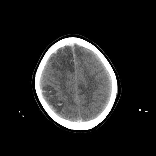 File:Cerebral venous throbmosis - hemorrhagic venous infarction (Radiopaedia 87318-103613 Axial non-contrast 135).jpg