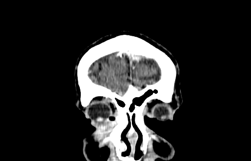 Cerebral venous thrombosis (CVT) (Radiopaedia 77524-89685 C 2).jpg