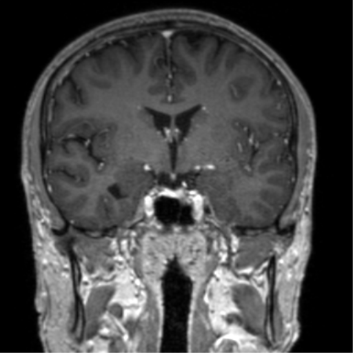 Cerebral venous thrombosis (Radiopaedia 38392-40469 Coronal T1 C+ 50).png