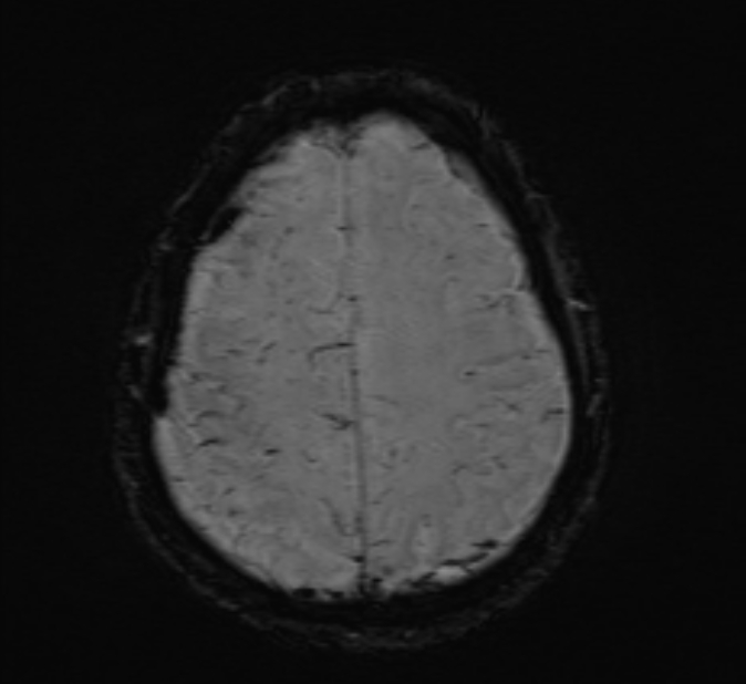 Cerebral venous thrombosis (Radiopaedia 71207-81504 Axial SWI 42).jpg