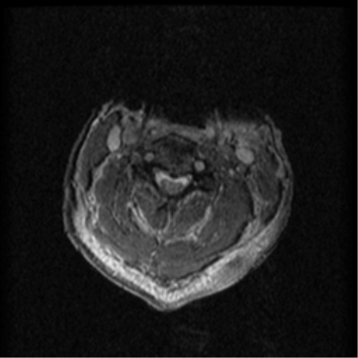 Cervical canal stenosis with cord compression (Radiopaedia 34114-35374 Axial Gradient Echo 59).png