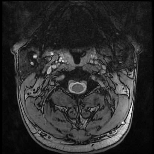 Cervical disc extrusion (Radiopaedia 59074-66364 G 2).jpg