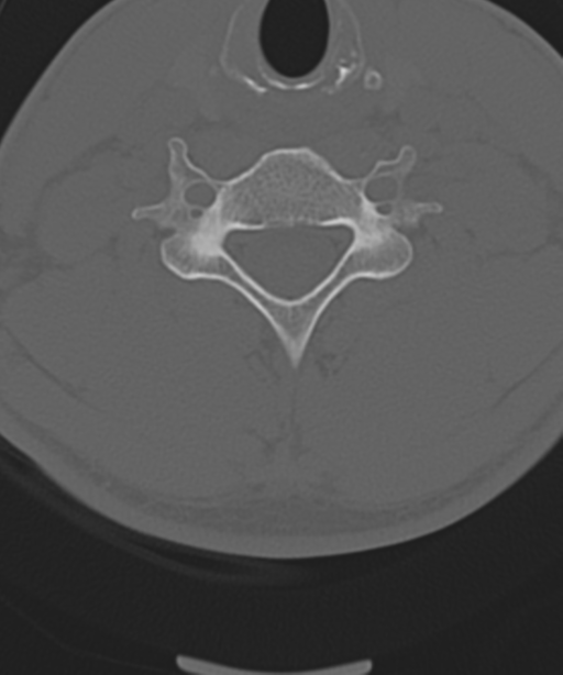 Cervical intercalary bone (Radiopaedia 35211-36748 Axial bone window 44).png