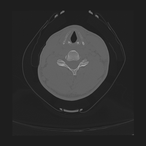 Cervical intercalary bone (Radiopaedia 35211-36748 Coronal bone window 1).png