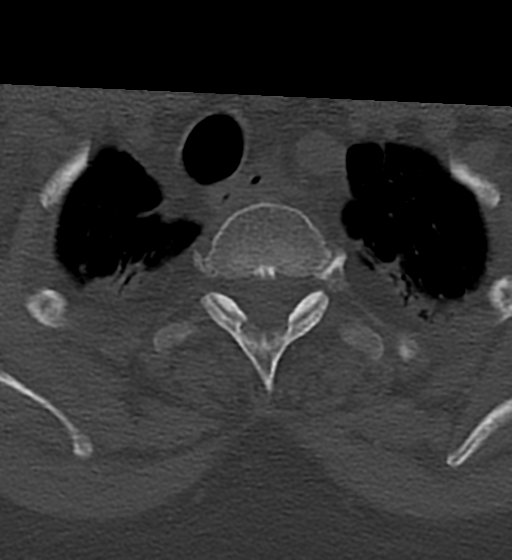 Cervical spine ACDF loosening (Radiopaedia 48998-54070 Axial bone window 59).png