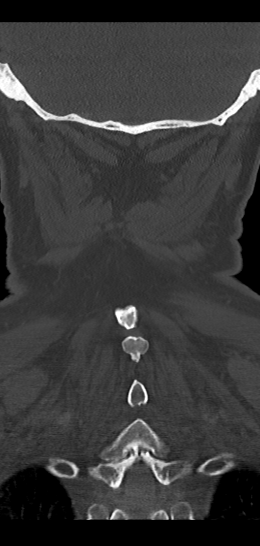 Cervical spine fracture - chalk stick (Radiopaedia 39116-41323 Coronal bone window 44).png