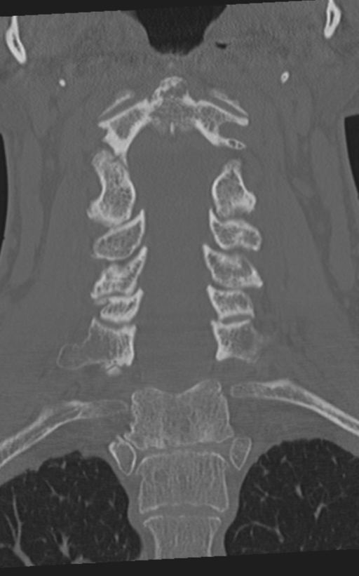 Cervical spine fractures with vertebral artery dissection (Radiopaedia 53296-59268 Coronal bone window 33).png