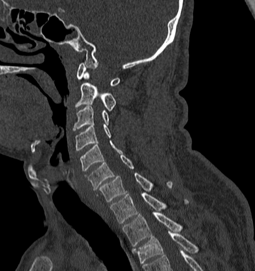 Cervical spine trauma with tear drop fracture and perched facet joint (Radiopaedia 53989-60127 Sagittal bone window 63).jpg