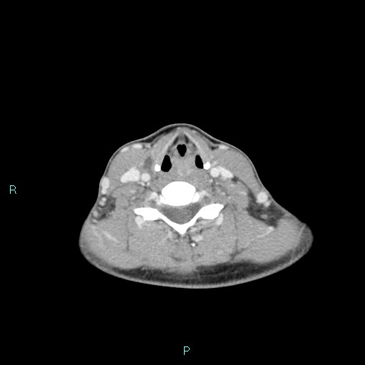 Cervical thymic cyst (Radiopaedia 88632-105335 C 51).jpg