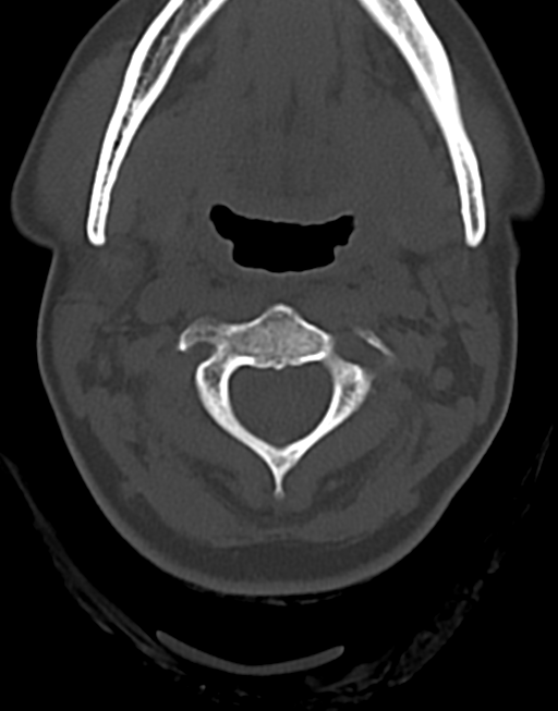 Cervical tuberculous spondylitis (Radiopaedia 39149-41365 Axial bone window 17).png