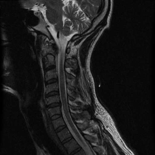 File:Cervical vertebrae metastasis (Radiopaedia 78814-91667 Sagittal T2 7).png