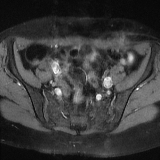 File:Cesarian section scar endometriosis (Radiopaedia 66520-75799 Axial T1 fat sat 6).jpg