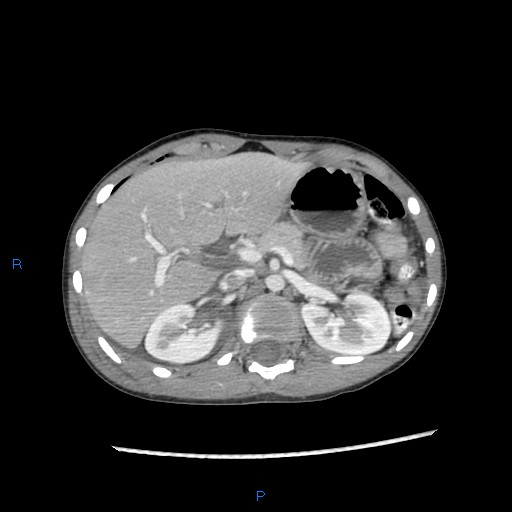 File:Chance fracture with duodenal and pancreatic lacerations (Radiopaedia 43477-46864 A 4).jpg