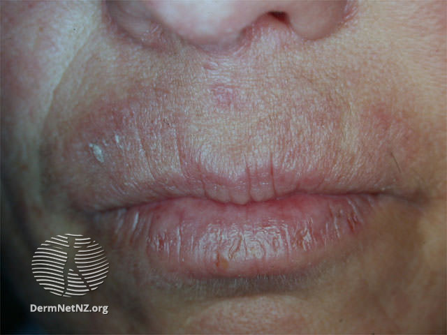 File:Cheilitis due to hair dye allergy (DermNet NZ dermatitis-lips-ppd).jpg