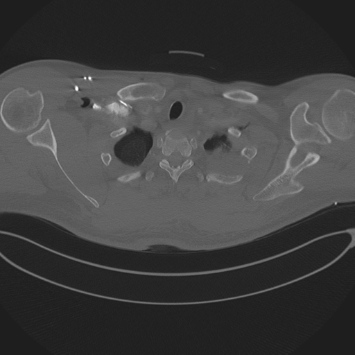 Chest multitrauma - aortic injury (Radiopaedia 34708-36147 Axial bone window 31).png