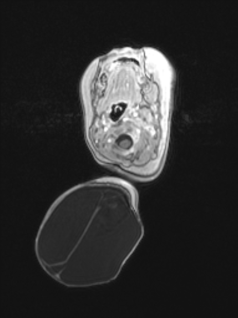 Chiari III malformation with occipital encephalocele (Radiopaedia 79446-92559 Axial T1 C+ mpr 24).jpg