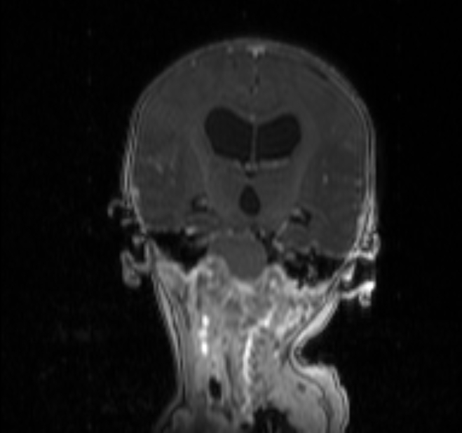 Chiari III malformation with occipital encephalocele (Radiopaedia 79446-92559 Coronal T1 C+ mpr 17).jpg