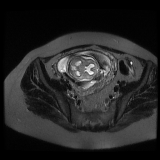 Chiari II malformation - fetal MRI (Radiopaedia 68099-77581 Axial T2-SSFSE 43).jpg