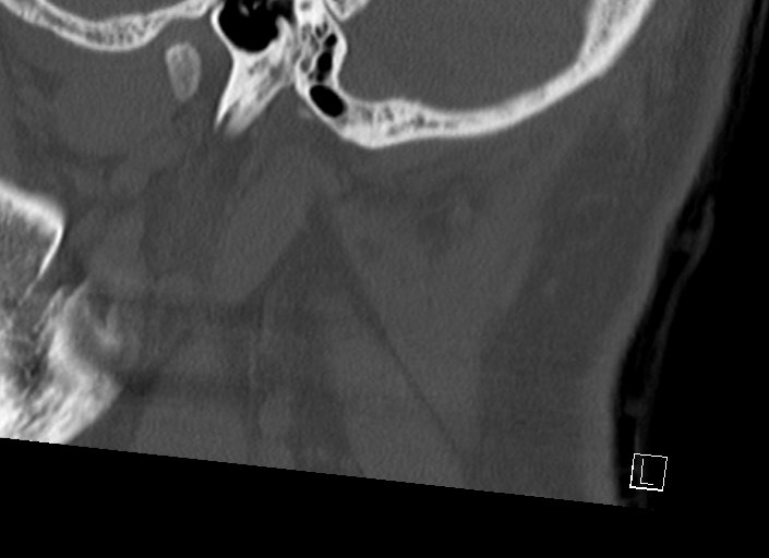 Chiari I malformation with a symptomatic syrinx of the posterolateral medulla oblongata (Radiopaedia 42573-45707 A 53).jpg