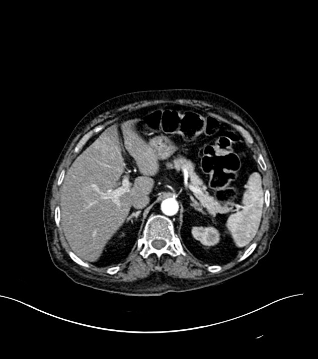Cholangiocarcinoma with cerebral metastases (Radiopaedia 83519-98629 B 23).jpg