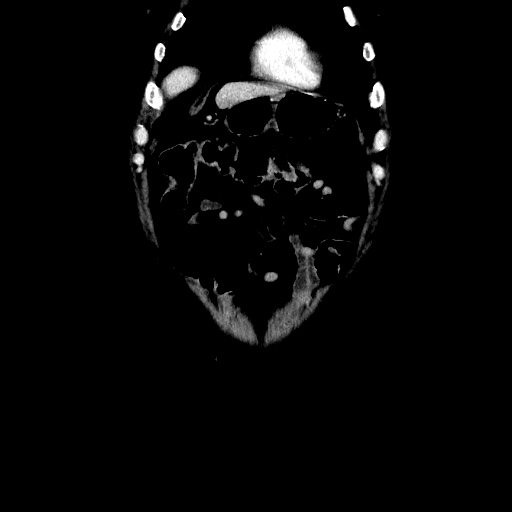 Choledocholiathiasis with normal caliber common bile duct (Radiopaedia 75368-86632 Coronal liver window 27).jpg