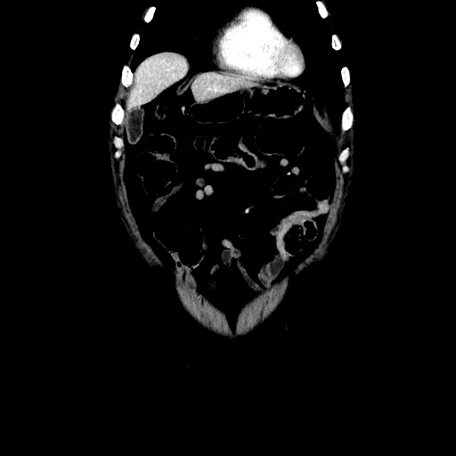 Choledocholiathiasis with normal caliber common bile duct (Radiopaedia 75368-86632 Coronal liver window 32).jpg