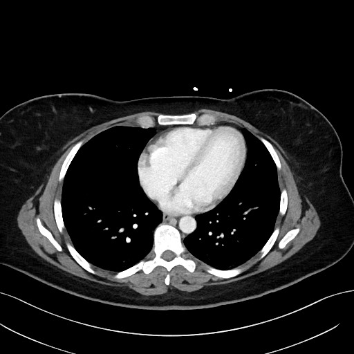 File:Choledocholithiasis after recent cholecystectomy (Radiopaedia 60929-68737 Axial 69).jpg