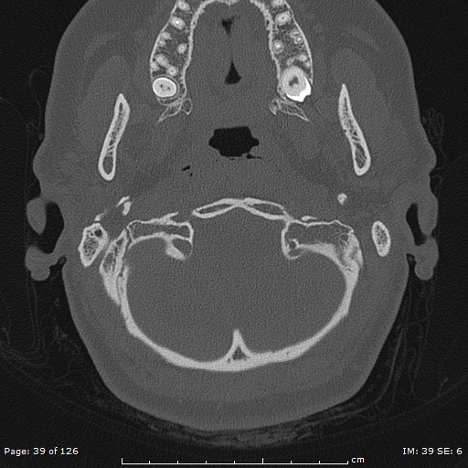 Cholesteatoma - external auditory canal (Radiopaedia 88452-105096 Axial bone window 2).jpg