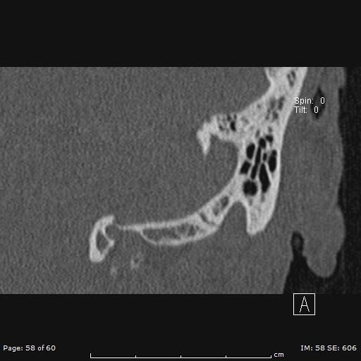 Cholesteatoma - external auditory canal (Radiopaedia 88452-105096 Coronal bone window 58).jpg