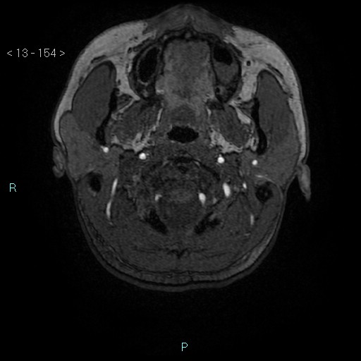 Cholesterol granuloma of the petrous apex (Radiopaedia 64358-73140 Axial TOF 3D 74).jpg