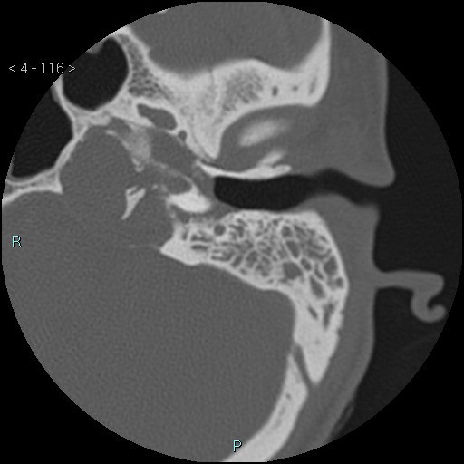 File:Cholesterol granuloma of the petrous apex (Radiopaedia 64358-73141 Axial bone window 56).jpg