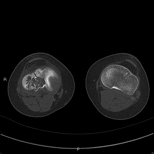 Chondroblastoma (Radiopaedia 62721-71030 Axial bone window 46).jpg
