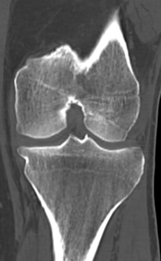 Chondrocalcinosis (Radiopaedia 82862-97173 Coronal bone window 47).jpg