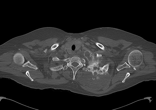 Chondrosarcoma - chest wall (Radiopaedia 65192-74199 Axial bone window 14).jpg