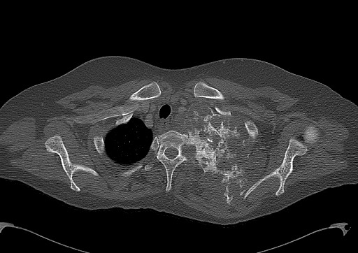 Chondrosarcoma - chest wall (Radiopaedia 65192-74199 Axial bone window 20).jpg