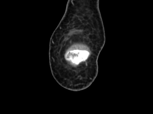 Chondrosarcoma - femur (Radiopaedia 64187-72954 C 3).jpg
