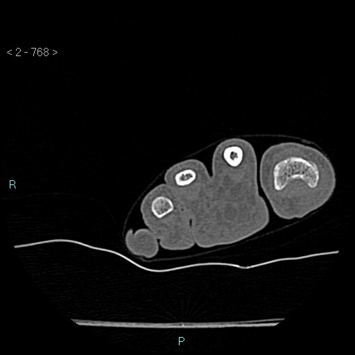 Chondrosarcoma - phalanx (Radiopaedia 69047-78812 Axial bone window 22).jpg