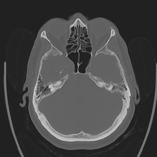 Chondrosarcoma of skull base- grade II (Radiopaedia 40948-43653 Axial bone window 13).png