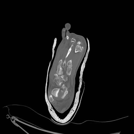 File:Chopart fracture (Radiopaedia 12386-12650 Axial bone window 7).jpg
