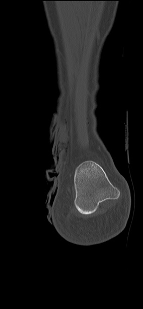 Chopart fracture (Radiopaedia 35347-36851 Coronal bone window 10).jpg
