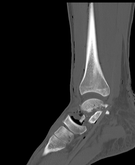Chopart fracture (Radiopaedia 35347-36851 Sagittal bone window 35).jpg