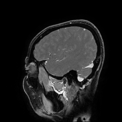 Chordoid glioma of third ventricle (Radiopaedia 91612-109340 F 53).jpg
