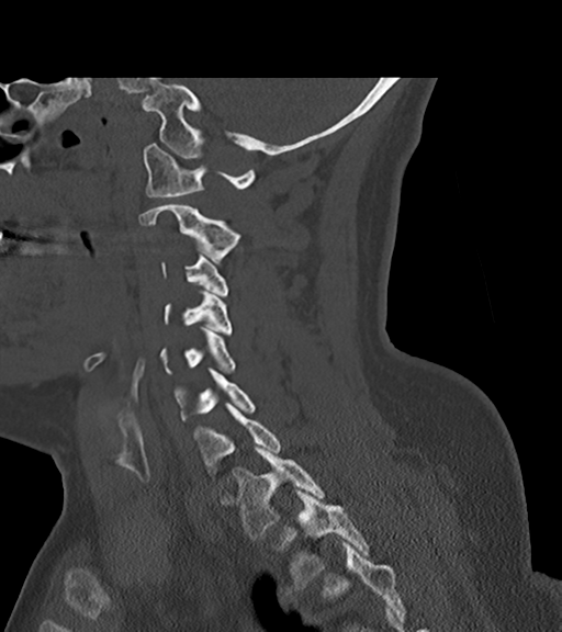 File:Chordoma (C4 vertebra) (Radiopaedia 47561-52188 Sagittal bone window 30).png
