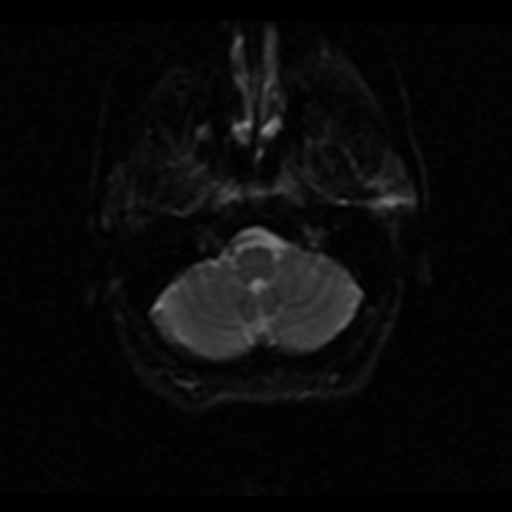 File:Choroid plexus xanthogranuloma (Radiopaedia 17650-17386 ADC 21).jpg