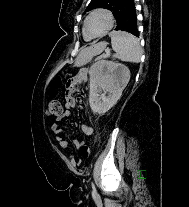 Chromophobe renal cell carcinoma (Radiopaedia 84239-99519 G 33).jpg
