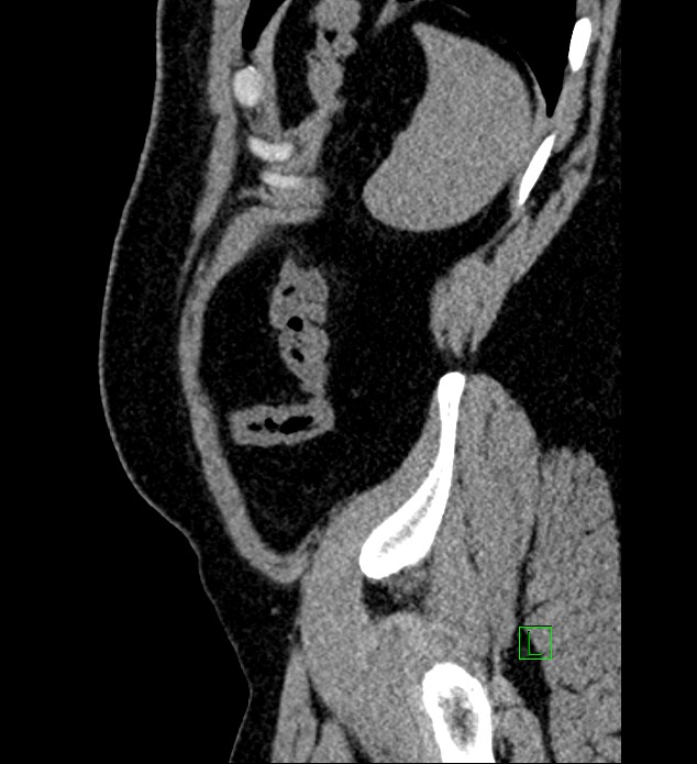 Chromophobe renal cell carcinoma (Radiopaedia 84286-99573 C 17).jpg